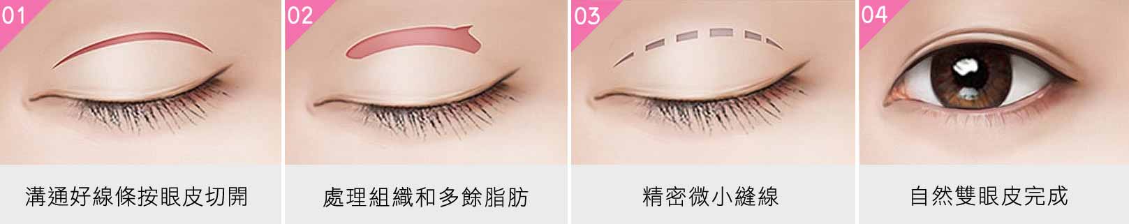 韓后-韓式無痕割雙眼皮方式：1.溝通好線條按眼皮切開。2.處理組織和多餘脂肪。3.精密微小縫線。4.自然雙眼皮完成。