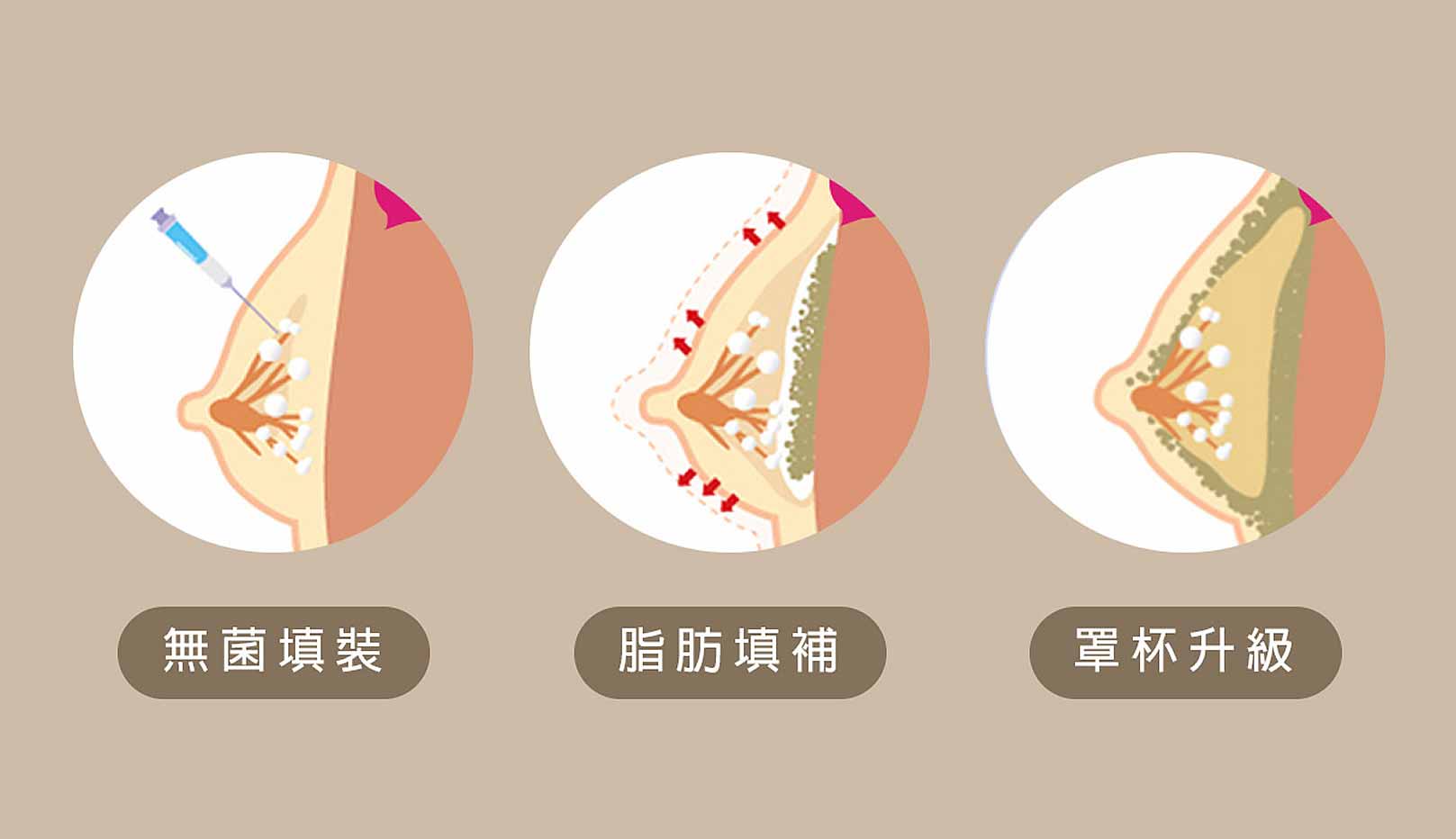 韓后醫美 自體脂肪豐胸：無菌填裝、脂肪填補、罩杯升級。