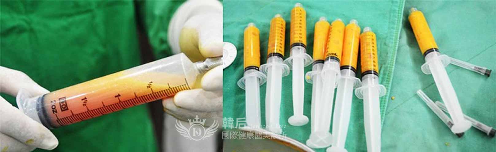 韓后醫美 自體脂肪豐胸 可抽取脂肪的部位