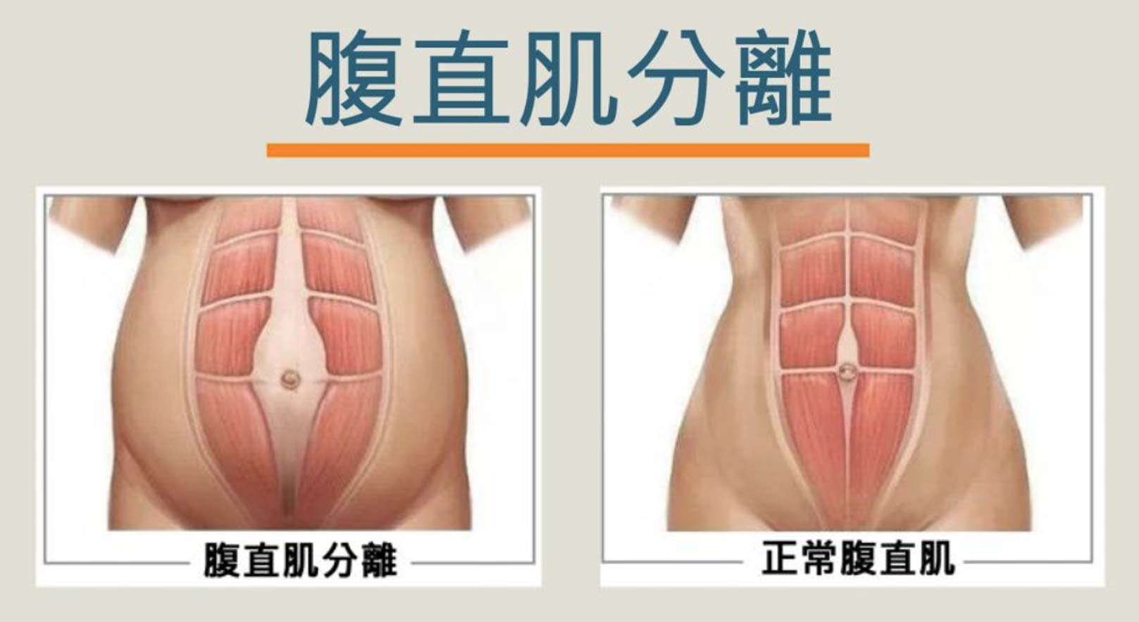 腹直肌分離,韓后醫美,動磁波,Talent-A