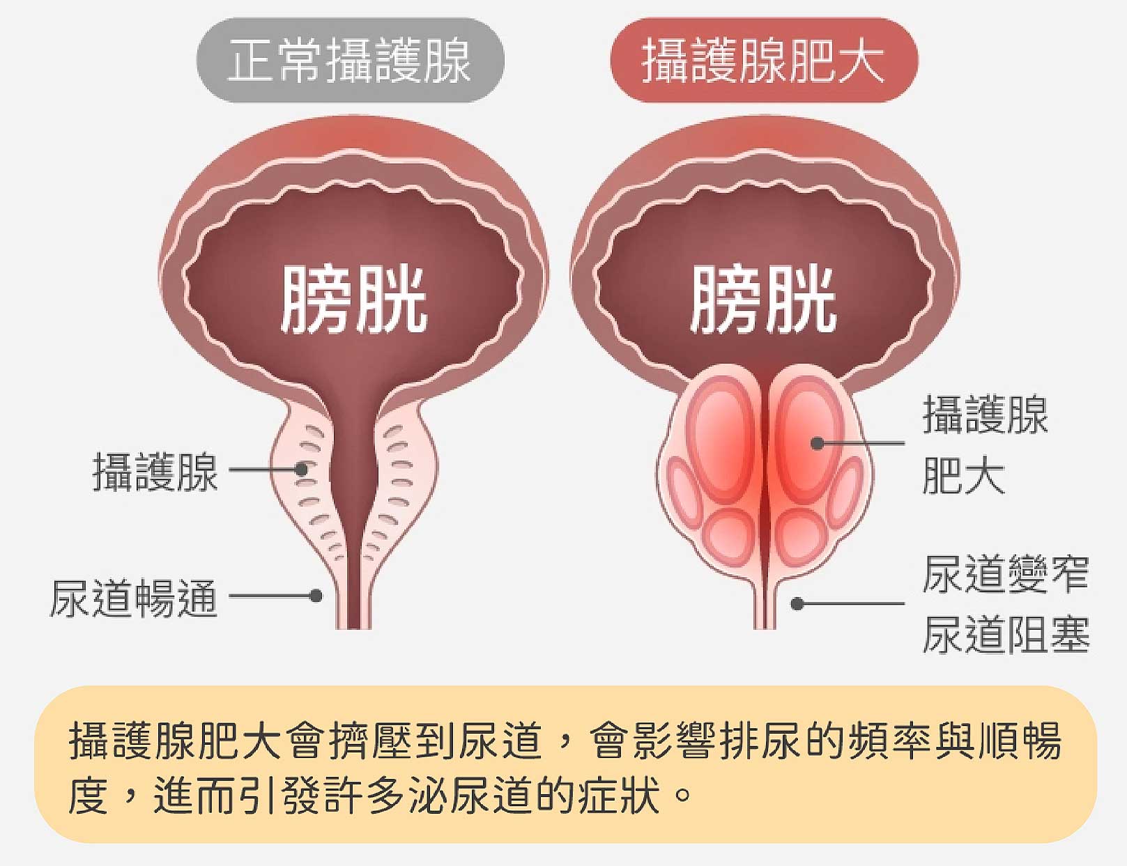 韓后醫美,正常攝護腺,尿道暢通。攝護腺肥大,尿道變窄,尿道阻塞。攝護腺肥大會擠壓到尿道，會影響排尿的頻率與順暢度，進而引發許多泌尿道的症狀。